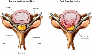 Normal vs. Herniated Disc